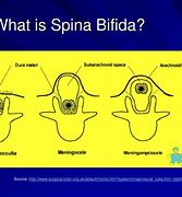 Image result for Spina Bifida Folic Acid