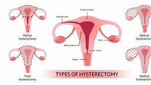 Image result for Hysterectomy Fibroids