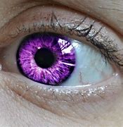 Image result for Chlamydia in Eye