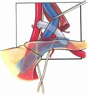 Image result for Carotid Artery Bypass