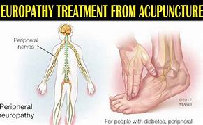 Image result for Acupuncture Points for Neuropathy