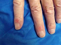 Image result for Cancer On Finger