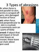 Image result for Skin Tear vs Abrasion