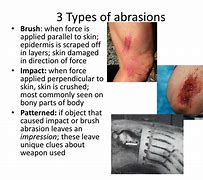 Image result for Pea Size Abrasion