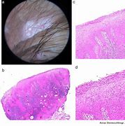 Image result for HPV Condyloma