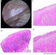 Image result for CDC Condyloma