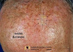 Image result for Actinic Keratosis Cryotherapy