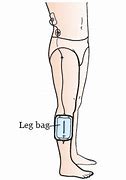 Image result for How to Wear a Nephrostomy Bag