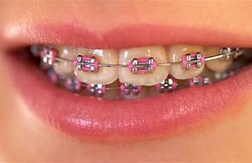 Image result for Pink Ceramic Braces