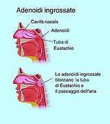Image result for adenoeo