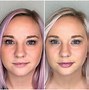 Image result for Filler for Lines around Mouth