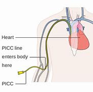 Image result for Chemo PICC Line