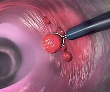 Image result for 1 mm Polyp in Colon