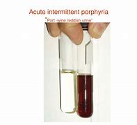 Image result for Port Wine Urine