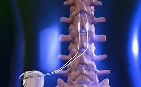 Image result for Back Nerve Stimulator