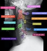 Image result for Cervical Spine Top-Down View in MRI