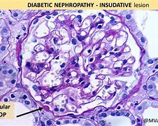 Image result for Diabetic Nephropathy Histology