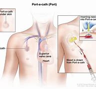 Image result for PICC Line Ports
