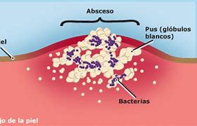 Image result for absdeso