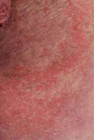 Image result for Biological Washing Powder Allergy Symptoms