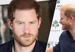 Image result for Prince Harry Hair Loss
