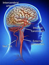 Image result for Carotid Artery Model