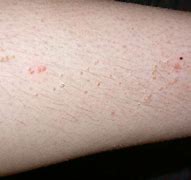 Image result for Common Flat Warts