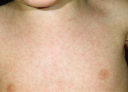Image result for Viral Infection Rash Symptoms