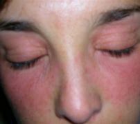 Image result for alergia