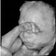 Image result for Anencephaly 8 Week Ultrasound