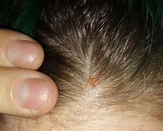 Image result for Red Scabs On Scalp