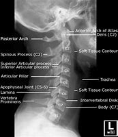 Image result for Cervical Spine X-ray Anatomy