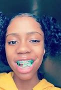 Image result for Black People with Braces