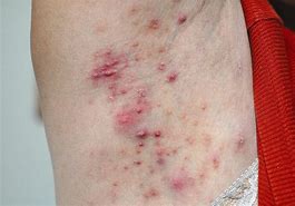 Image result for Pustules