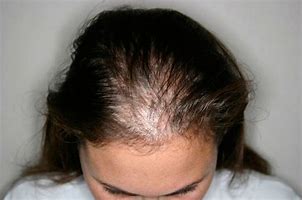 Image result for alopecis