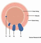 Image result for Bowel Cancer Diagram