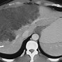 Image result for Egg Shell Calcificaction CT or Ultrasound Echinoccocus