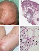 Image result for Disseminated Candidiasis