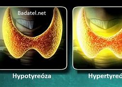 hypertyreoza 的图像结果