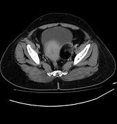 Image result for Ovarian Dermoid Radiology