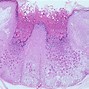 Image result for Molluscum Contagiosum Virus MCV