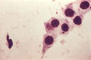 Image result for Chlamydia Trachomatis Test Kit