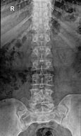 Image result for Spina Bifida Occulta X-ray