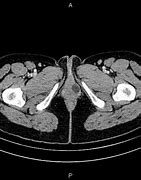 Image result for Genital Cyst