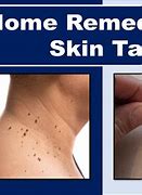 Image result for Natural Skin Tag Removal