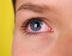 Image result for Scratch On Eye