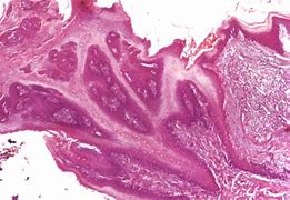 Image result for Squamous Cell Papilloma Tongue