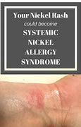Image result for Nickel Allergy Skin Rash