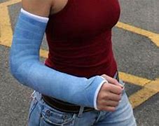 Image result for Full Arm Cast for ECU Injury