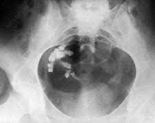 Image result for Dermoid Ovarian Cyst X-ray